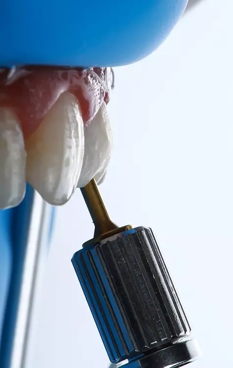 Abb. 17: Nach der Schichtung des zervikalen Bereichs
wird das Hybrid-Abutment für eine extraorale
Politur herausgeschraubt. Hier ist die erneute Verschraubung
mit einem Drehmoment von 25 Ncm
gezeigt.