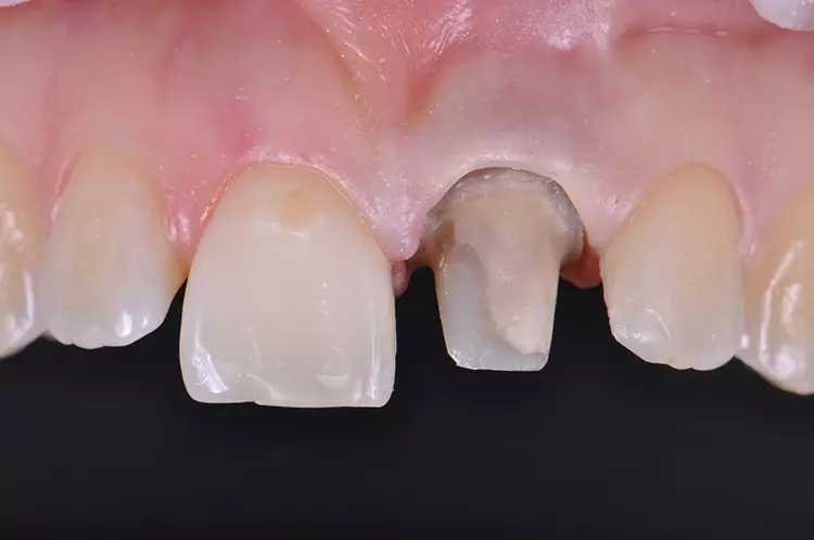 Abb. 17: Darstellung des Präparationsrandes mittels Retraktionsfaden
und Teflonband.