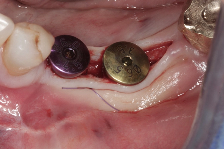 Abb. 17: Zustand nach Freilegung und Aufbringen der Gingivaformer.