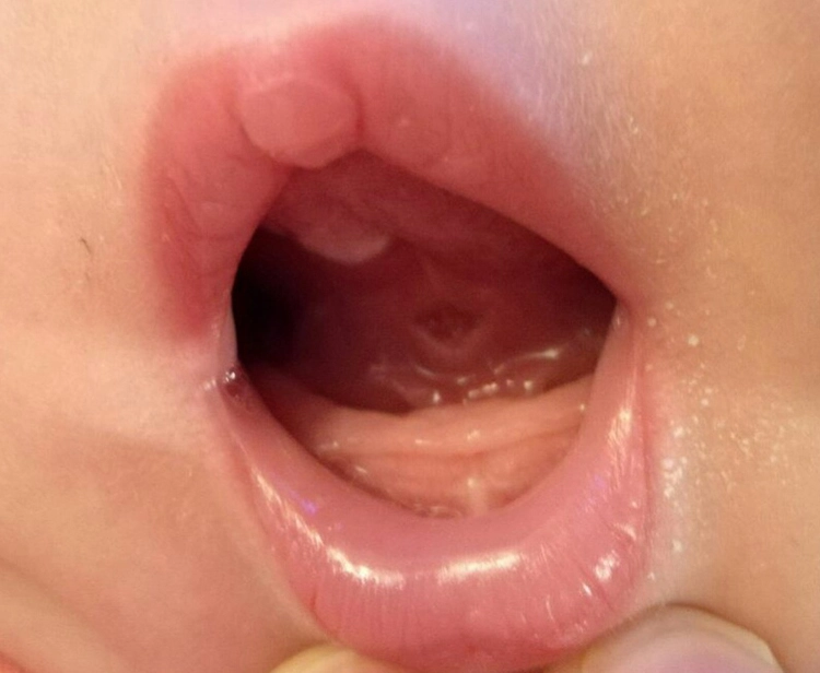 Abb. 18: Ruheposition getestet mit Tongue Posture Hold.