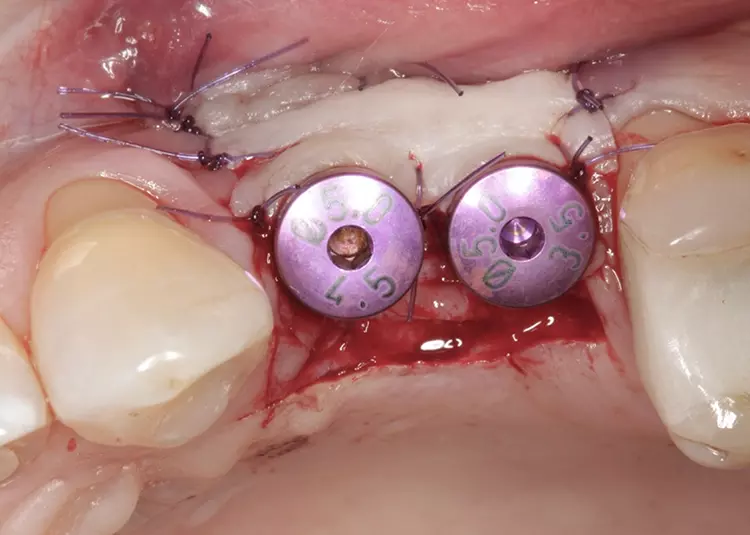 Abb. 18: Es erfolgt die Freilegung mittels apikalem Verschiebelappen und das
Aufbringen der Gingivaformer.