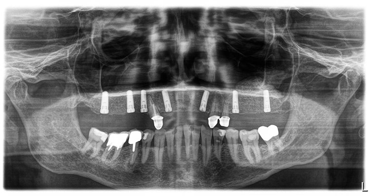 Abb. 18: Röntgenkontrollaufnahme nach Implantation (Implantate mit Abdeckschrauben verschlossen).