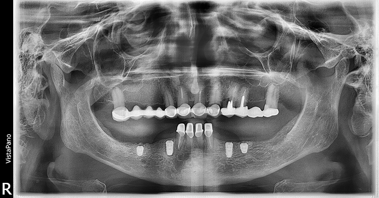 Abb. 18: Röntgenkontrollaufnahme nach Implantation (mit eingedrehten Deckschrauben).
