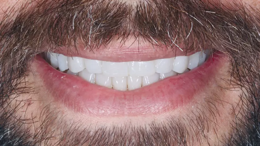 Abb. 18: Lächeln mit intraoral eingesetztem Mock-up.