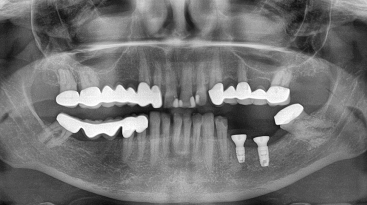 Abb. 18: Abschlussröntgenbild mit inserierten Gingivaformern.
