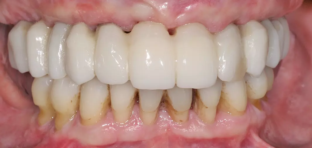 Abb. 18b: Situation drei Wochen postoperativ (retrahierte Lippen).