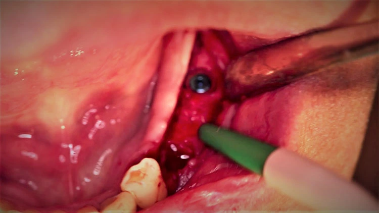 Abb. 19: Zwei Implantate wurden bone level inseriert.
