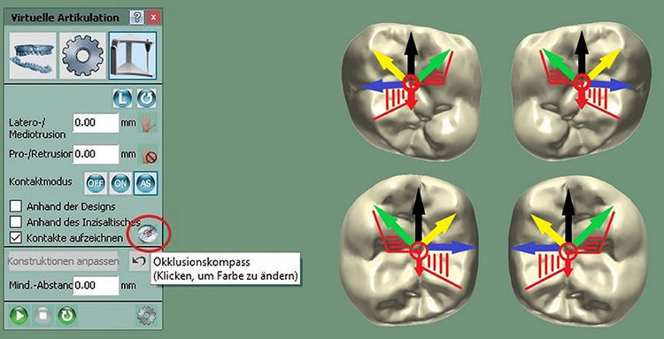 Abb. 19: Okklusaler Kompass mit farblichen Vektoren in der 3shape Software.