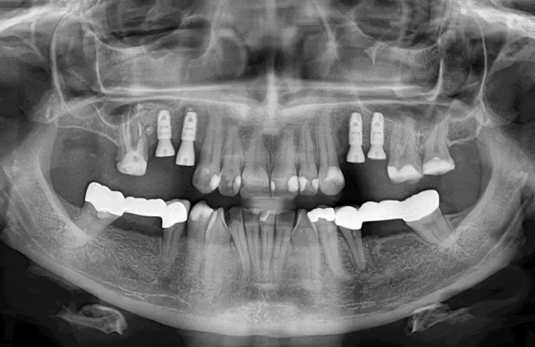 Abb. 19: Abschlussröntgenbild mit inserierten Gingivaformern.
