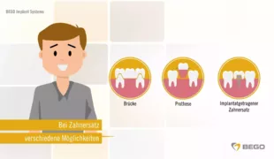 Das neue Video von BEGO Implant Systems beantwortet viele Patientenfragen zum Thema Zahnimplantate.