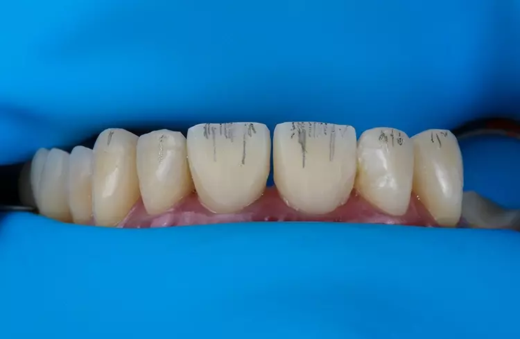 Abb. 19: Cut-back-Technik und Herstellung der palatinalen Schicht aus
transluzentem Komposit (Admira Fusion, Inzisal, VOCO).