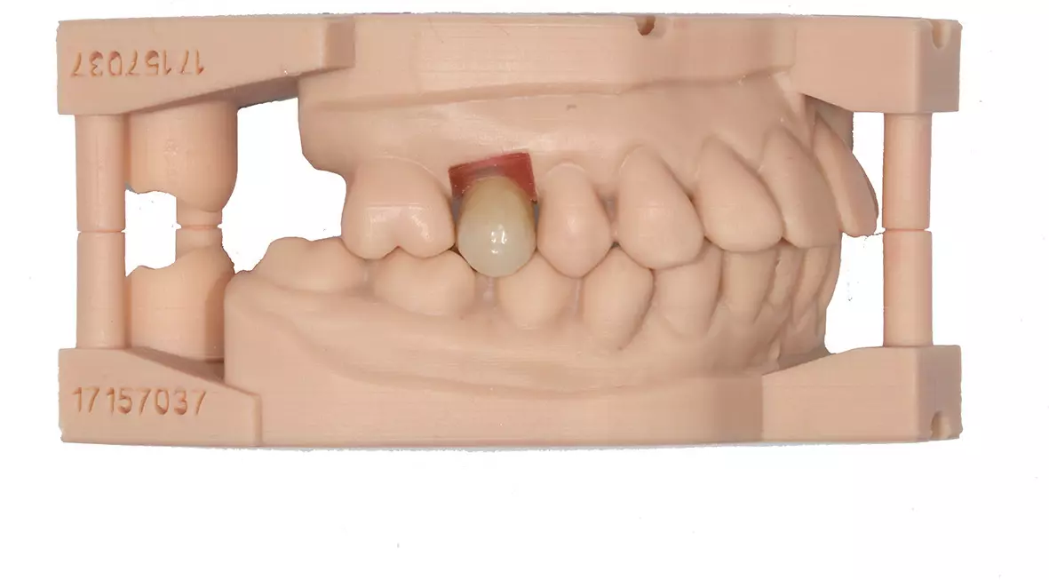 Abb. 19: Die monolithische, vestibulär verblendete Implantatkrone mit gedrucktem Quadranten-Modellpaar.