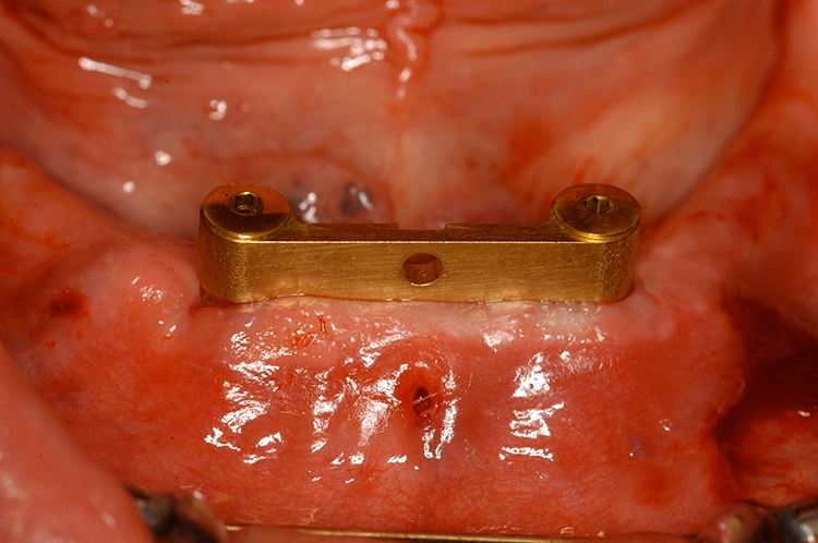 Abb. 19: Definitiv montierter gefräster Steg mit Riegel direkt nach der Implantation.