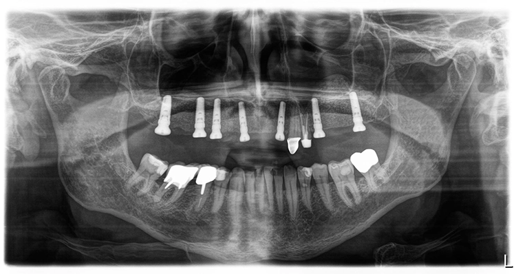 Abb. 19: Röntgenkontrollaufnahme (mit Gingivaformern) nach Socket Preservation i.r. 13.