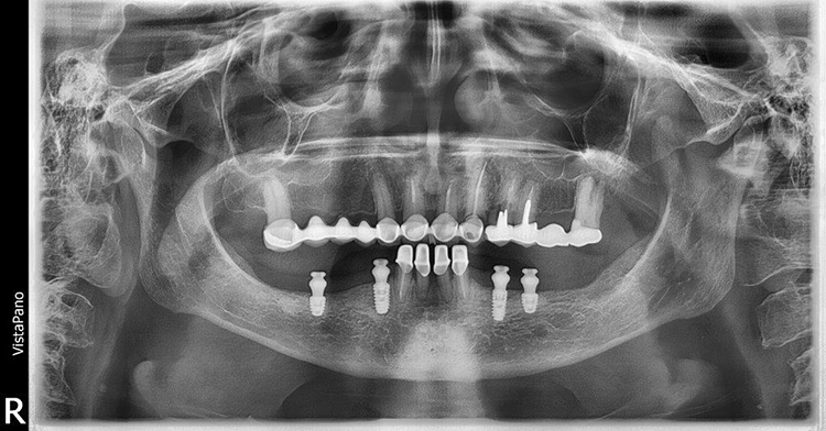 Abb. 19: Mit TiSi.snap versorgte copaSKY Implantate.