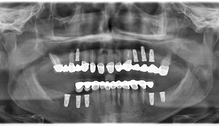 Abb. 19: Röntgenkontrollaufnahme nach Implantation und mit eingegliedertem Langzeitprovisorium.