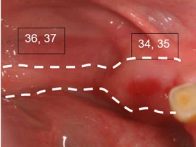 Kieferkammerhalt nach Extraktion regio 34, 35 mit Bio-Oss Collagen und 36,37 ohne Socket-Preservation.