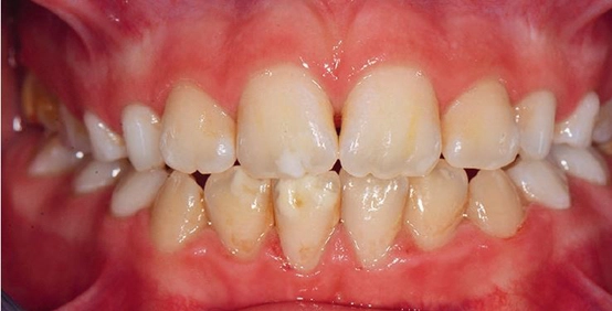 Abb. 1: Blickdiagnose: Molaren-Inzisiven-Hypomineralisation. Gut erkennbar sind die scharf begrenzten weiß-gelblichen Opazitäten.