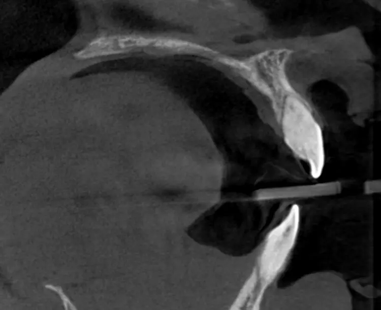 Abb. 1: Tomographischer Querschnitt des Zahnes 21 zeigt eine Veränderung
des Kronen-Wurzel-Verhältnisses und eine ausgeprägte Knochenkonkavität im
vestibulären apikalen Bereich.
