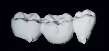 Abb. 1a: Die 3-gliedrige Brücke wurde aus IPS e.max ZirCAD Prime gefräst.