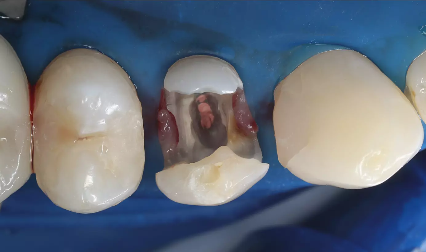Subgingivale Präparation für ein Keramik-Onlay.