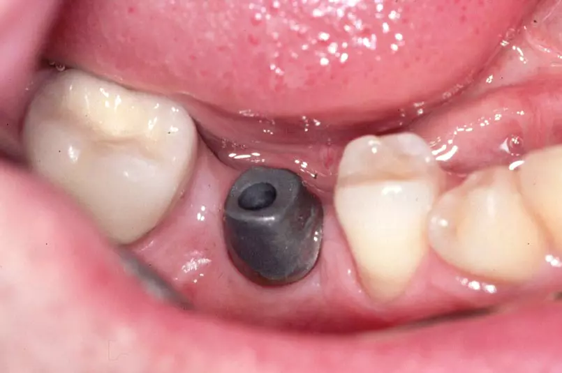 Abb. 1: Das Implantat in regio 46 mit Aufbau. Das Profile BiAbutment ist im Labor
individualisiert worden.