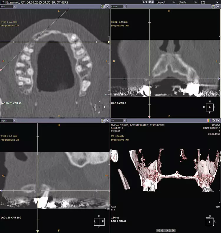 Abb.1: CT-Aufnahme der Ausgangssituation vor Bonespreading-Behandlung: Patientin (65 Jahre) mit atrophiertem Kieferkamm.