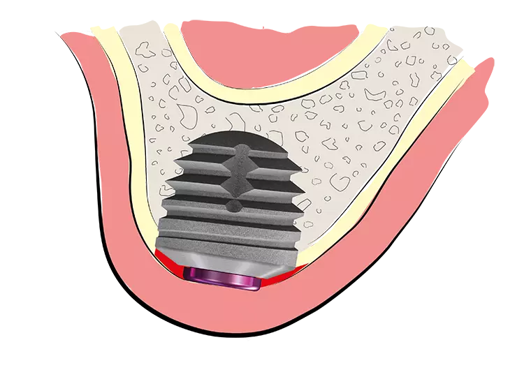 Abb. 1: Backtaper-Effekt durch Auflagerung von Knochenspänen auf der abgeschrägten Implantatschulter mit geätzter Oberfläche zur Gewebeadaption (rot markierter Bereich).