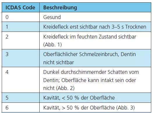 Tab. 1: Der ICDAS Code gibt Kriterien zur Unterscheidung verschiedener Stadien des kariösen Prozesses an die Hand.