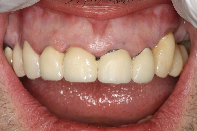 Abb. 1: Klinische Ausgangssituation mit breiter Gingiva und kurzen Kronen im Oberkiefer.
