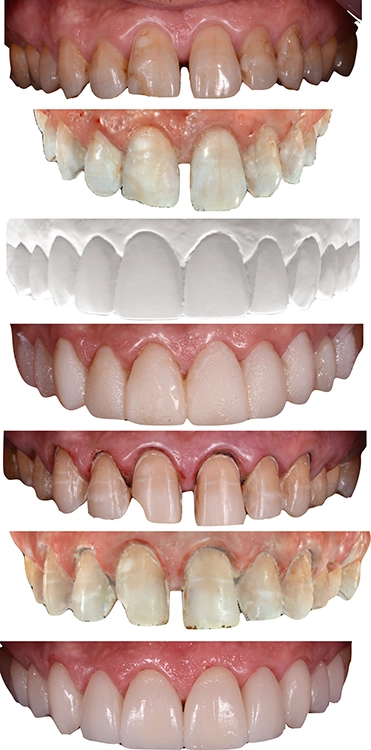 Für die Erstuntersuchung der Zähne, Abformungen sowie den Scan der Präparation wurde der Intraoralscanner CS 3600 von Carestream Dental verwendet.