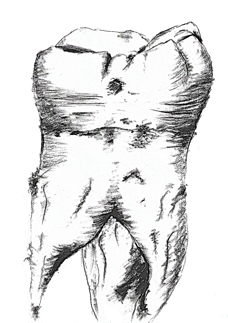 Abb. 1: Gezeichneter Zahn.