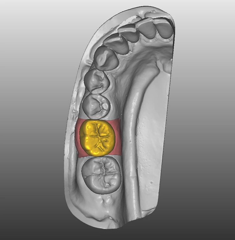 Abb. 1: Abgeschlossene Modellation einer Implantatkrone.