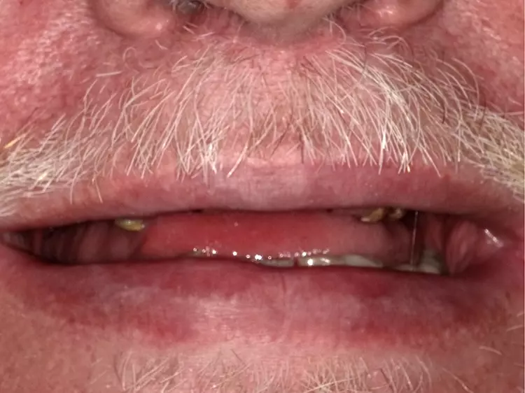 Abb. 1a: Ausgangssituation: Lächeln eines 61-jährigen Patienten mit dem
Wunsch nach einer festsitzenden Versorgung (Sofortversorgungskonzept).