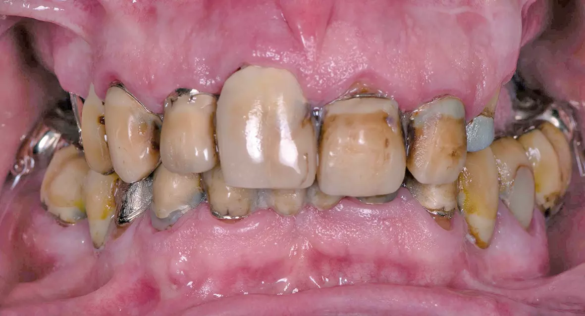 Abb. 1b: Ausgangssituation mit retrahierten Lippen.