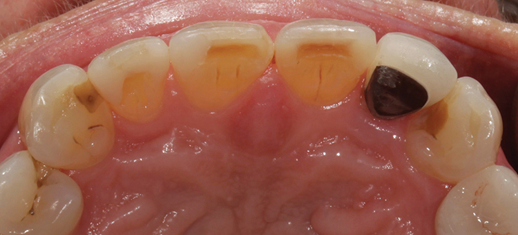 Abb. 2: Palatinalansicht der Oberkieferfrontzähne vor der Behandlung. Zahn 22 war
endodontisch mit einem Metallstift und einer Metallkeramik-Krone behandelt worden.