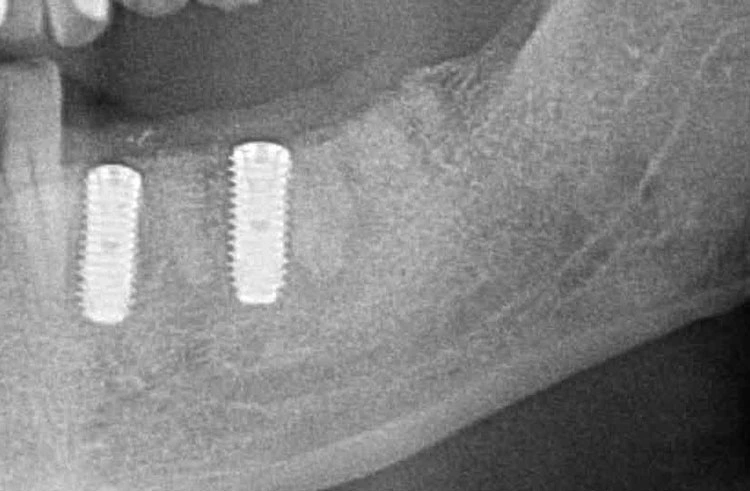 Abb. 20: Radiologische Kontrolle ein Tag nach der Implantation.