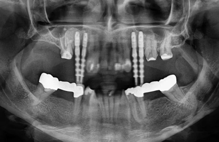 Abb. 20: Röntgenkontrollaufnahme während der Implantatabformung