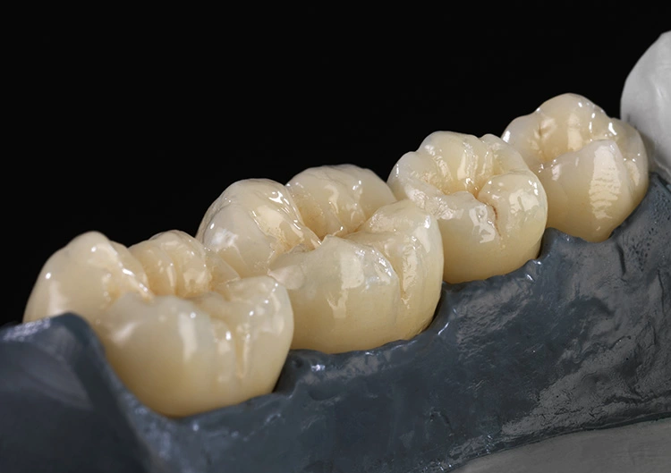 2013 Erster voreingefärbter Zolid Blank aus Zolid Preshape. Kronen 34–37, 34 reduziert, vollverblendet, 35 vestibulär verblendet, 36 zirkulär verblendet, 37 monolithisch, bemalt.