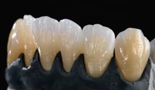 Erste monolithische Restaurationen im Frontzahnbereich aus Zolid FX White. Veneers 33–43 monolithisch , infiltriert und bemalt.