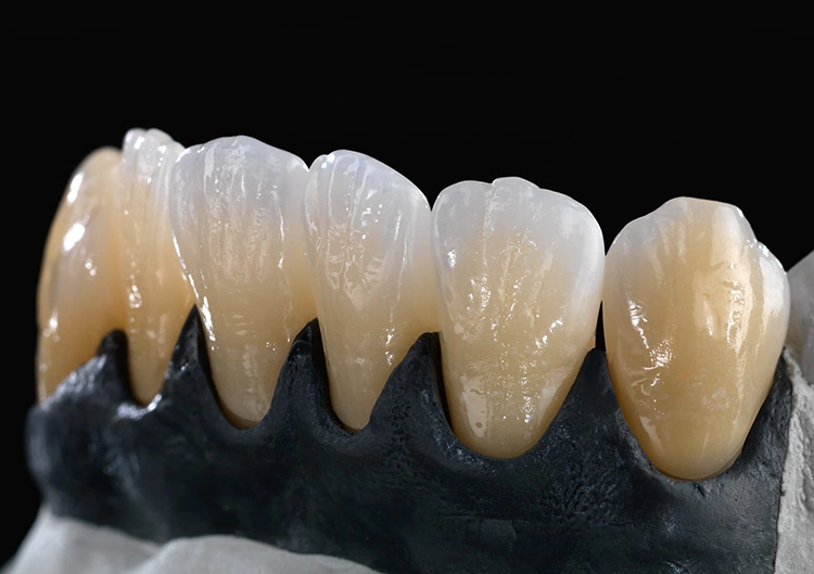 2014 Erste monolithische Restaurationen im Frontzahnbereich aus Zolid FX White. Veneers 33–43 monolithisch , infiltriert und bemalt.