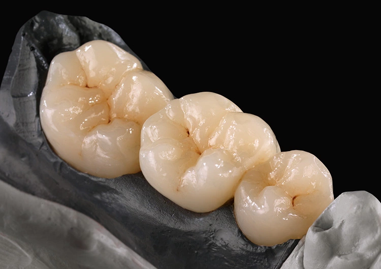 2015 Zolid FX Preshade: Brücke 35–37 monolithisch, bemalt.