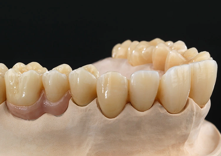 2018 Kombiarbeit Zolid HT+ White & Zolid FX ML: Implantatbrücke 16–26 (Zolid HT+ white) vestibulär und Gingiva Cutback, Rest monolithisch. Molarenkronen 16, 17, 27 (Zolid FX ML) monolithisch, bemalt und glasiert.