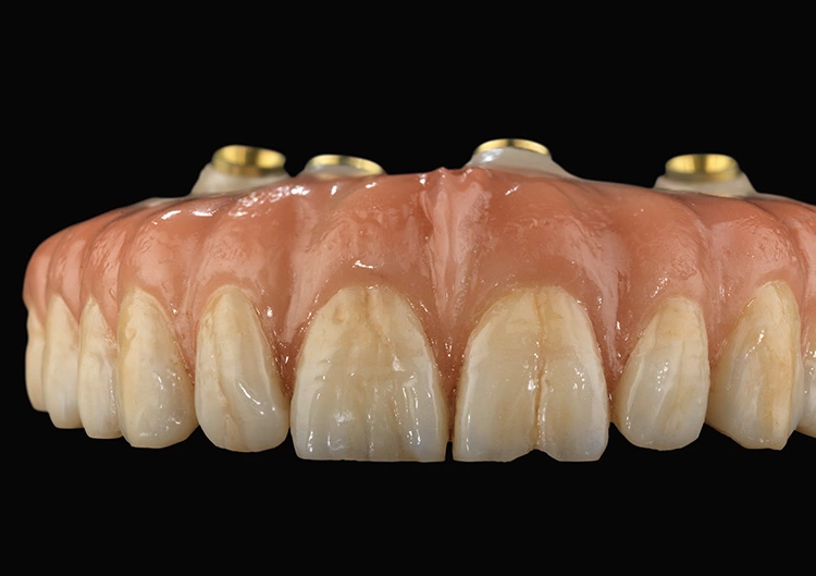 2019 Zolid HT+ Preshade: REAX Brücke, 13–23 vestibulär und Gingiva Cutback, Rest monolithisch.