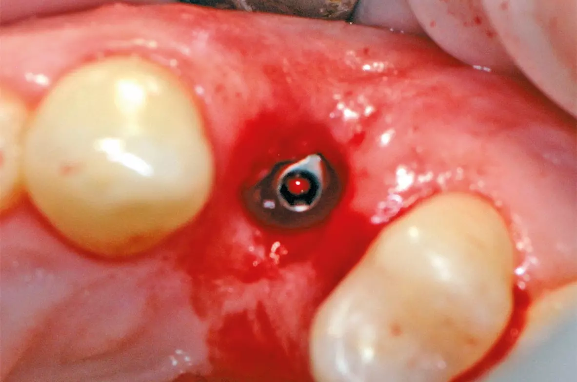 Abb. 20: Implantatinsertion in regio 24 drei Monate nach der Zahnextraktion.