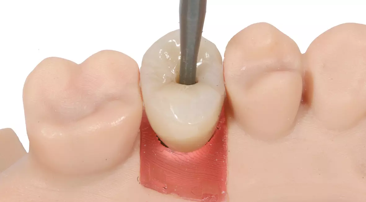 Abb. 20: Verschrauben der Implantatkrone auf dem Modell mit Laboranalog.