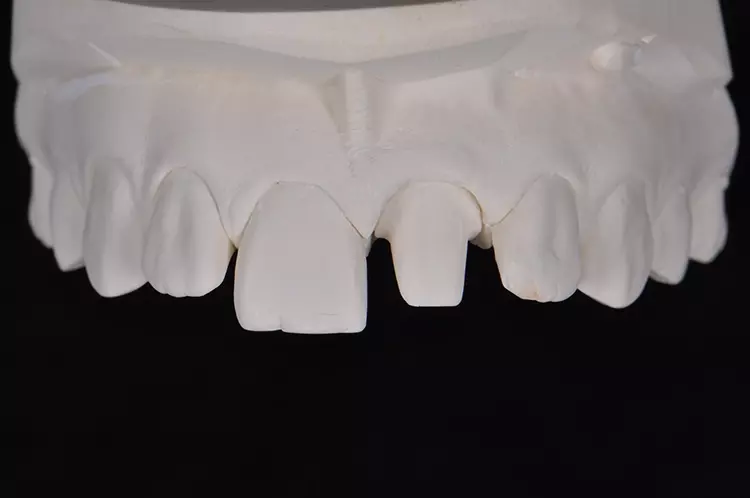 Abb. 20: Klassische Abformung mithilfe eines individuellen Löffels und eines Polyethermaterials.