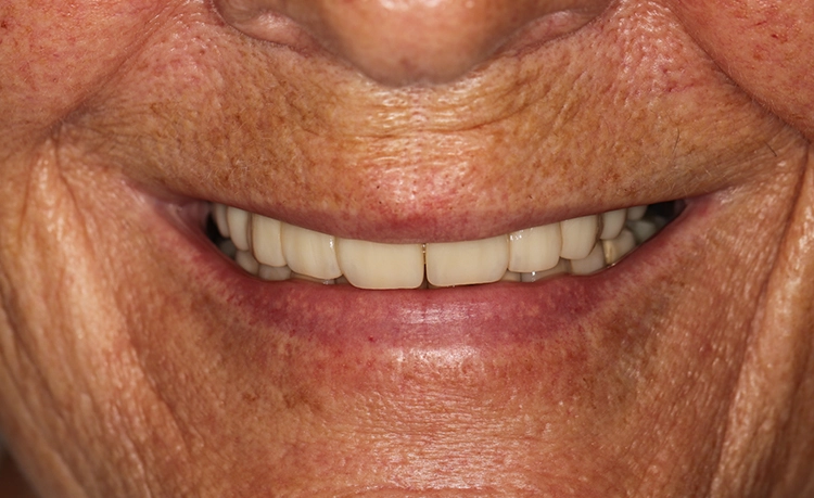 Abb. 20: Lippenbild nach Abschluss der Behandlung.