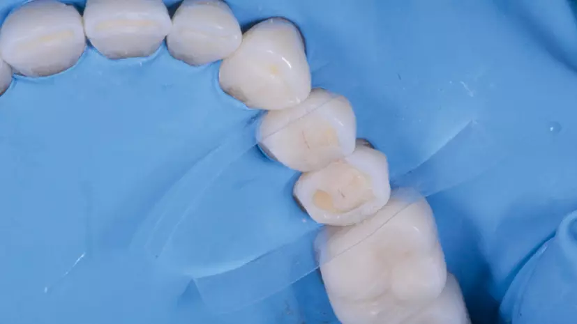Abb. 20: Zustand nach dem Scan des Mock-ups mit dem Intraoral-Scanner CS3600, der Konditionierung der Innenflächen und nach dem Spülen.