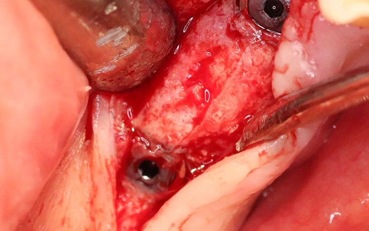 Abb. 21: Knochen bei Freilegung acht Wochen nach der Implantation.